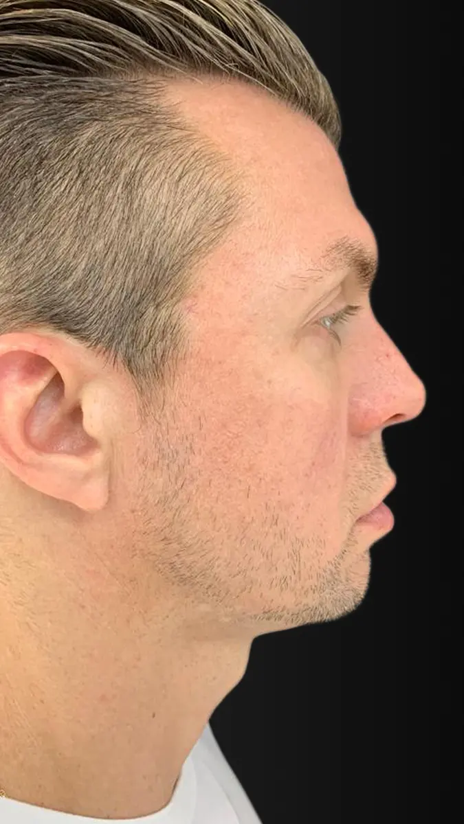 Antes y después de definición de ángulos faciales en Medellín – Dr. Carlos Arroyave