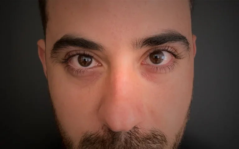 Antes y después de tratamiento de ojeras en Medellín – Dr. Carlos Arroyave
