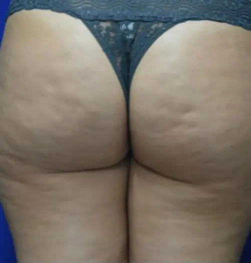 Antes y después de Sculptra en Medellín – Dr. Carlos Arroyave