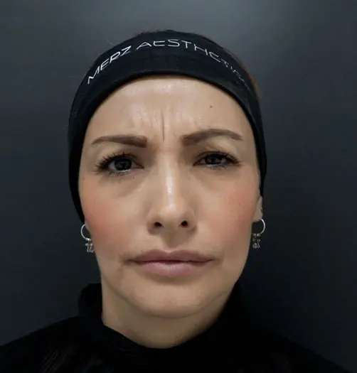 Antes y después de toxina botulínica en Medellín – Dr. Carlos Arroyave