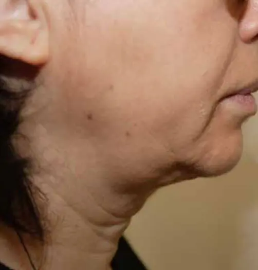Antes y después de Ultraformer III en Medellín – Dr. Carlos Arroyave