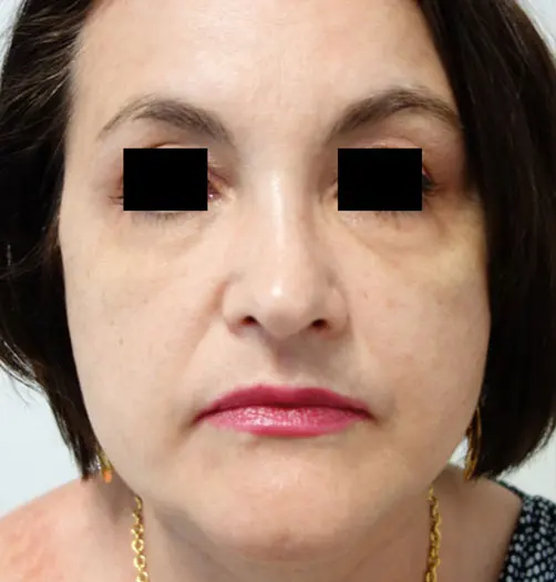 Antes y después de Ultraformer III en Medellín – Dr. Carlos Arroyave