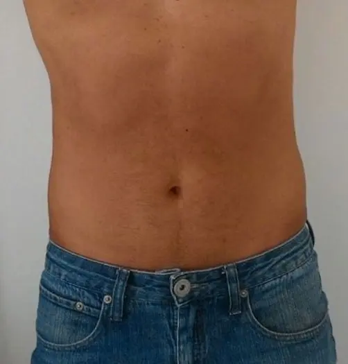 Antes y después de Ultraformer III en Medellín – Dr. Carlos Arroyave